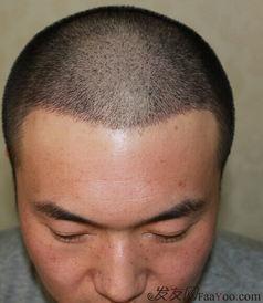 植发搞笑回答,脱发危机？植发界的欢乐喜剧